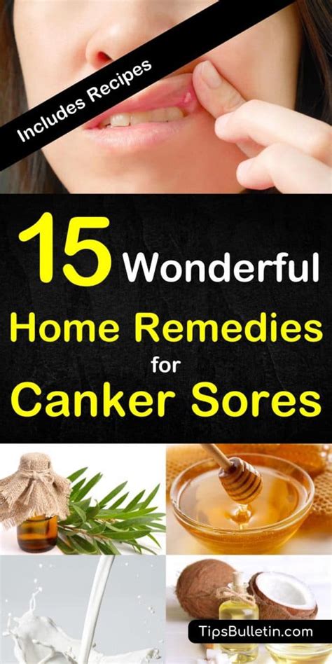 How To Get Rid Of A Canker Sore 15 Wonderful Home Remedies