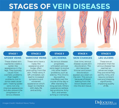 Varicose Veins Symptoms Causes And Natural Support Strategies