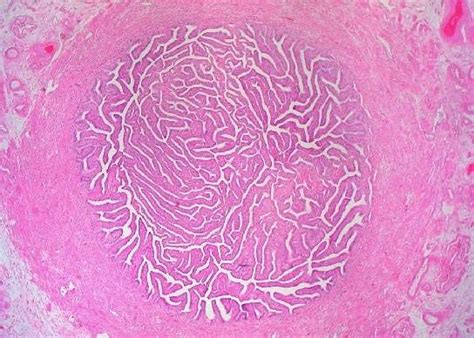 blocked fallopian tubes tubal disease create fertility