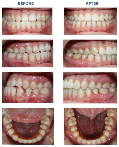 comprehensive anterior crossbite midline shift before and after braces pinterest