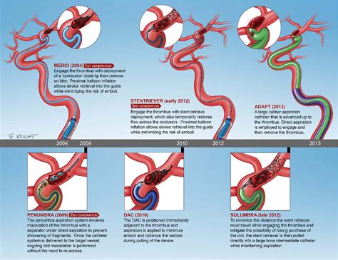 evolution  thrombectomy approaches  devices  acute stroke