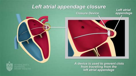 left atrial appendage closure st vincents heart health