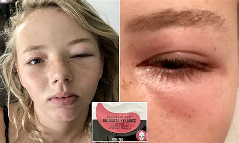 mum claims daughter was unable to open eye after using kmart mask