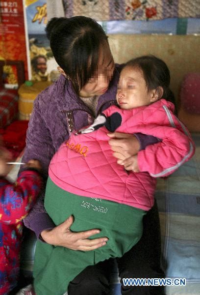 girl at 4 has swollen belly due to unknown disease people s daily online