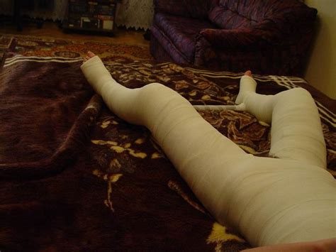 dhs double hip spica cast      body cast leg cast  cast