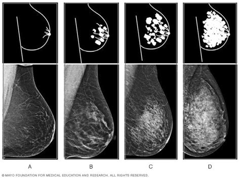 breast density — the four levels mayo clinic