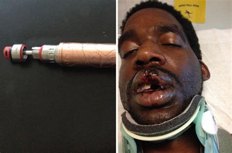 Man Left With Broken Neck After E Cigarette Explodes Daily Star