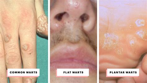 types  warts    treat   visual guide allure