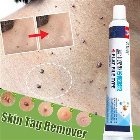 skin tag remover genital wart treatment papillomas removal of warts