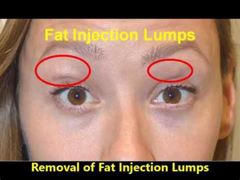 removing eyelid fat injection lumps granulomas youtube