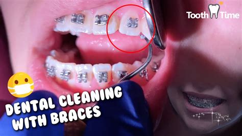 dental cleaning  braces braces checkup  cleaning appointment