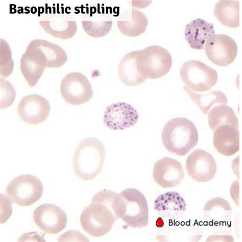 basophilic stippling    punctate basophilia blood academy