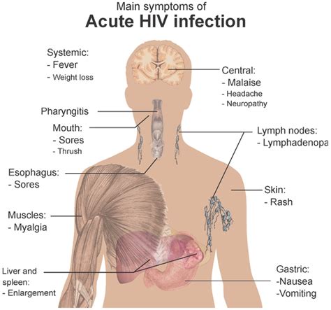 hiv aids physiopedia