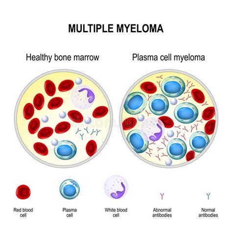 multiple myeloma plasma cell myeloma royalty  illustration poster