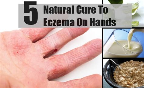 5 natural cure for eczema on hands how to cure eczema on