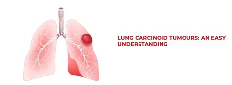 Lung Carcinoid Tumours An Easy Understanding Bmchrc