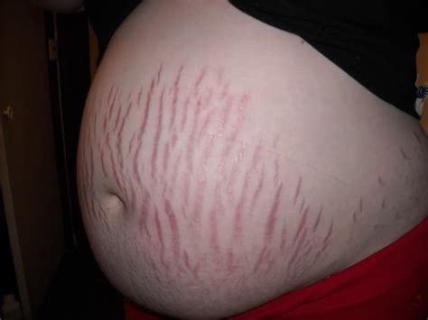 stretch marks during pregnancy pictures 7 photos and images