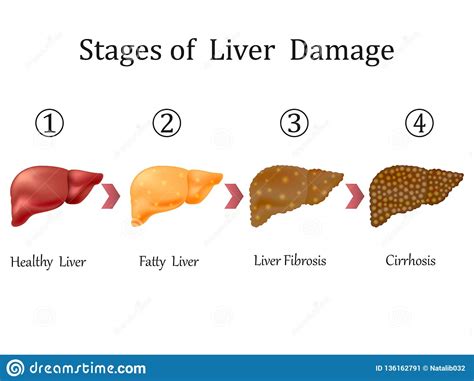 Stages Of Liver Damage Liver Disease Healthy Fatty Liver Fibrosis