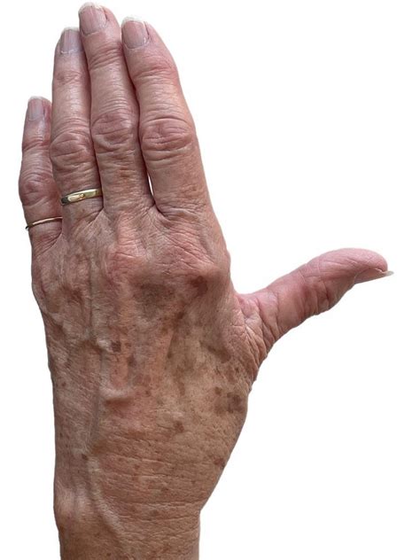 duim artrose oefenthuis
