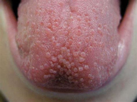 tongue bumps      doctor  treatment