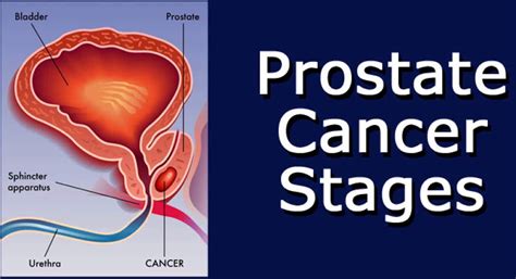 prostate cancer signs  symptoms diagnosis stages treatment