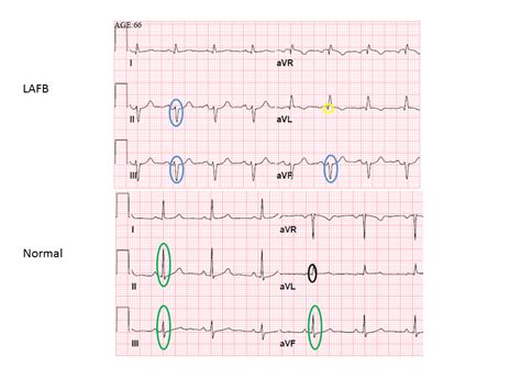 Routine Ekg Finding Could Signal Serious Heart Problem