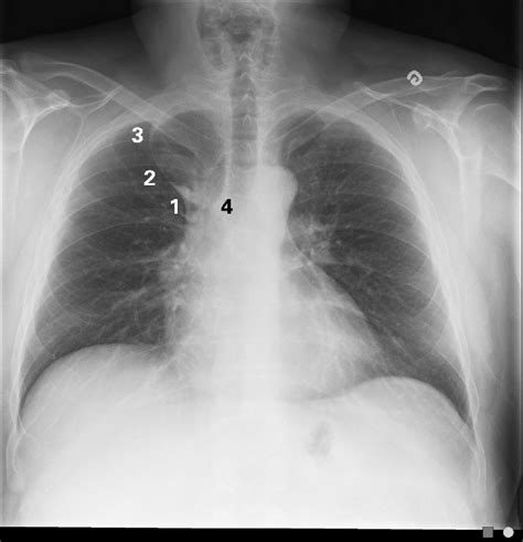 Chest X Ray Showing A Curvilinear Shadow Spanning The Apex Of The Right
