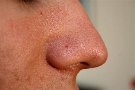 medical pictures info blackhead