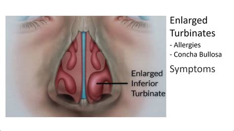 enlarged nasal turbinates symptoms  treatment youtube
