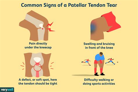 patellar tendon tear symptoms   treatment