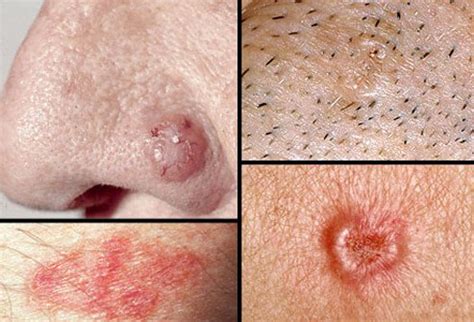 basal cell carcinoma bcc