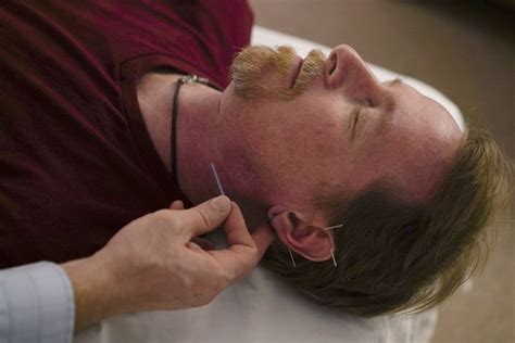 stuck in an opioids crisis officials turn to acupuncture