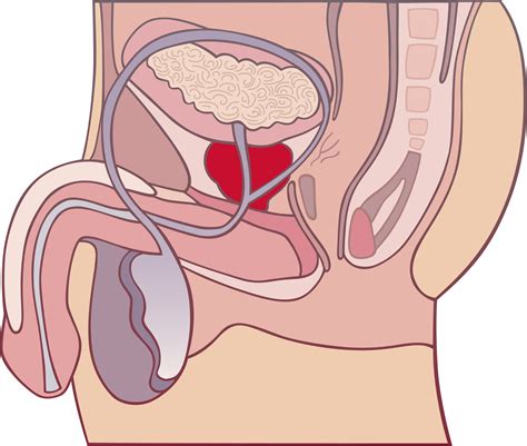 enlarged prostate sexual symptoms healthfully