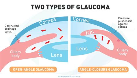 types  glaucoma primary open angle glaucoma primary angle