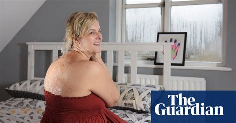 Living With Disfigurement ‘i’m Proud Of My Scars’ Health And Wellbeing
