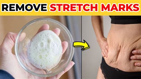 How To Get Rid Of Stretch Marks Naturally At Home And Fast Youtube