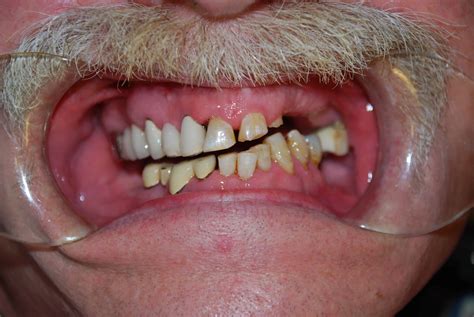 partial dentures  avenue dental