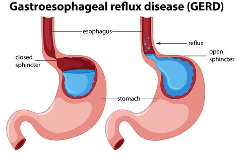 gastroesophageal reflux disease anatomy  vector art  vecteezy