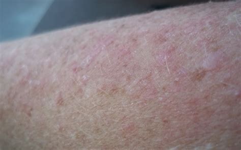 marys page living  lupus  lupus rash
