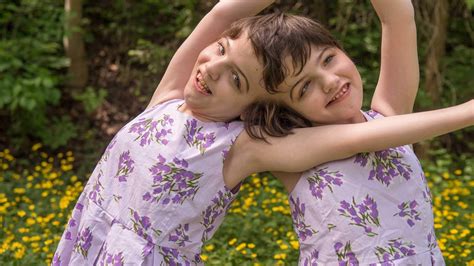 Til Of Hogan Sisters Conjoined Twins Who Share A Brain Therefore They