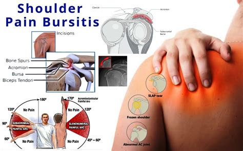 shoulder pain bursitis homeopathy treatmentmedicines  bursitis pain