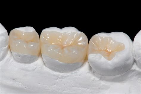 porcelain inlays onlays tooth repair tatiana vazira dds