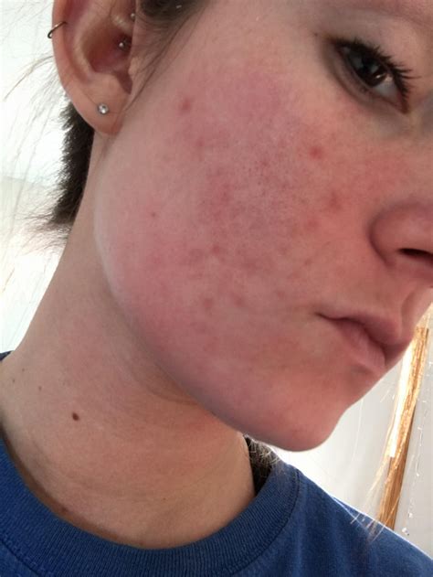 horrible post acne marks scar treatments  lo acneorg community
