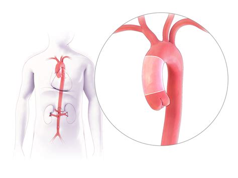 emory aortic center patient education