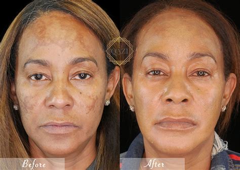 pico laser treatment  goodbye  skin imperfections