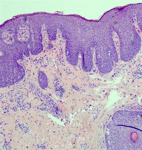 pathology outlines lichen sclerosus