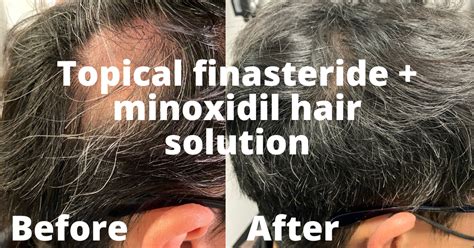 Topical Hair Loss Solution Topical Finasteride And Minoxidil Rejuvla