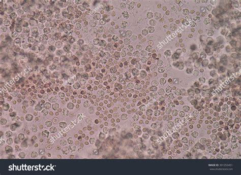 bacteria white blood cells urine stock photo