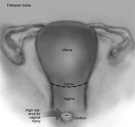 Neobladder‐vaginal Fistula After Cystectomy And Orthotopic
