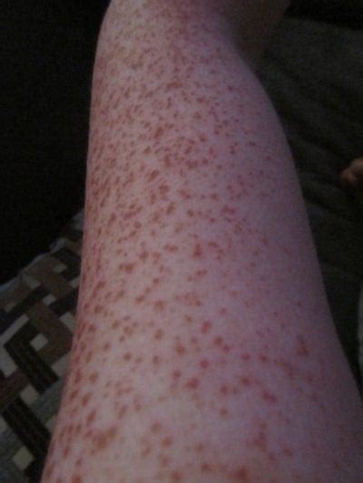 Ipl Laser On Arms For Freckles Ipl Review Realself